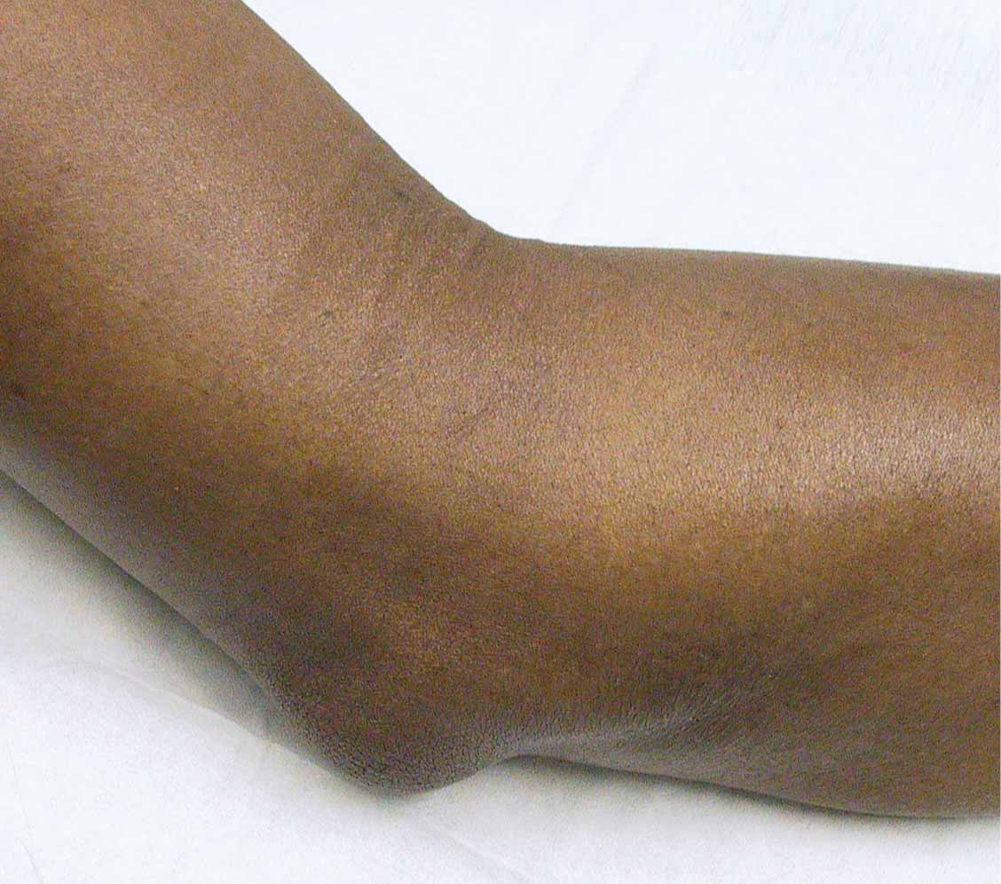 Olecranon Bursitis