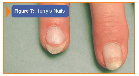 Leukonychia Vs Terry S Nails - Nail Ftempo