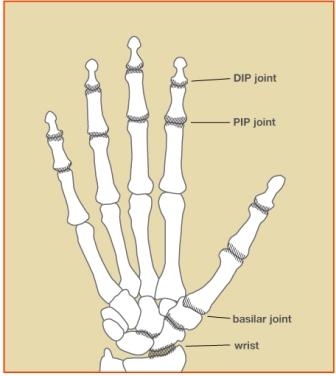 Image showing Osteoarthritis