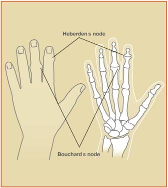 OsteoArthritis