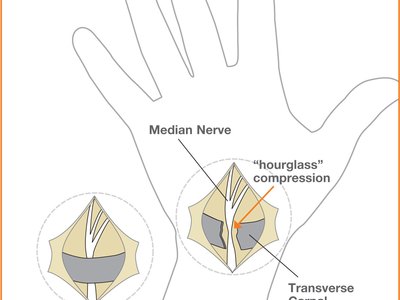 Carpal Tunnel Release