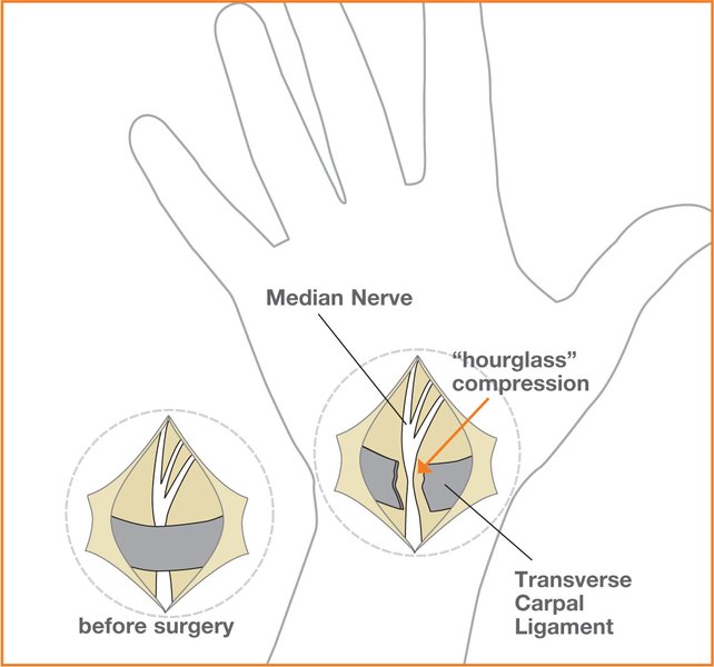 Carpal Tunnel Release