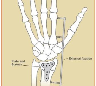 Wrist (Distal Radius) Fractures