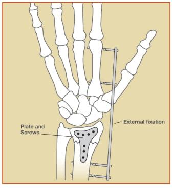 Wrist (Distal Radius) Fractures