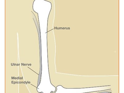 Cubital Tunnel Release