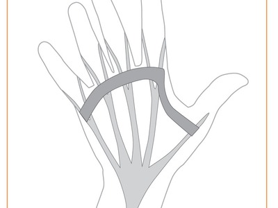 Dupuytrens Contracture Procedures