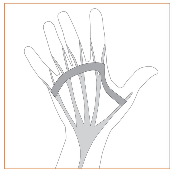 Dupuytrens Contracture Procedures