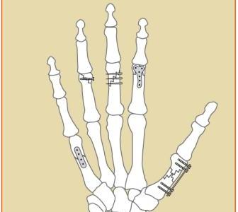 Hand Fracture Procedures