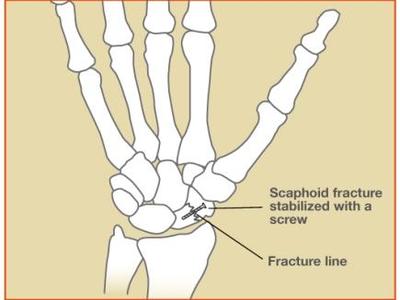 Scaphoid Fracture Procedures