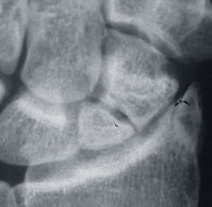 Scaphoid Nonunion Procedure