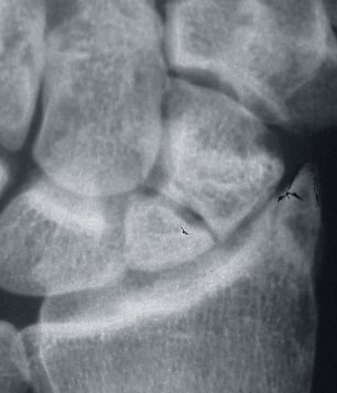 Scaphoid Nonunion Procedure