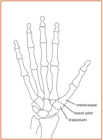 Trapeziectomy with Suspensionplasty