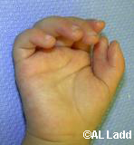 Rubinstein- Taybi Syndrome  Congenital Hand and Arm Differences