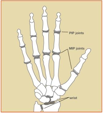 Rheumatoid Arthritis