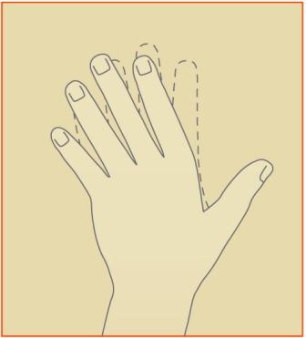 Rheumatoid Arthritis