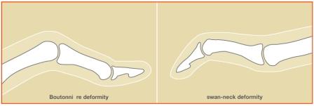 Rheumatoid Arthritis