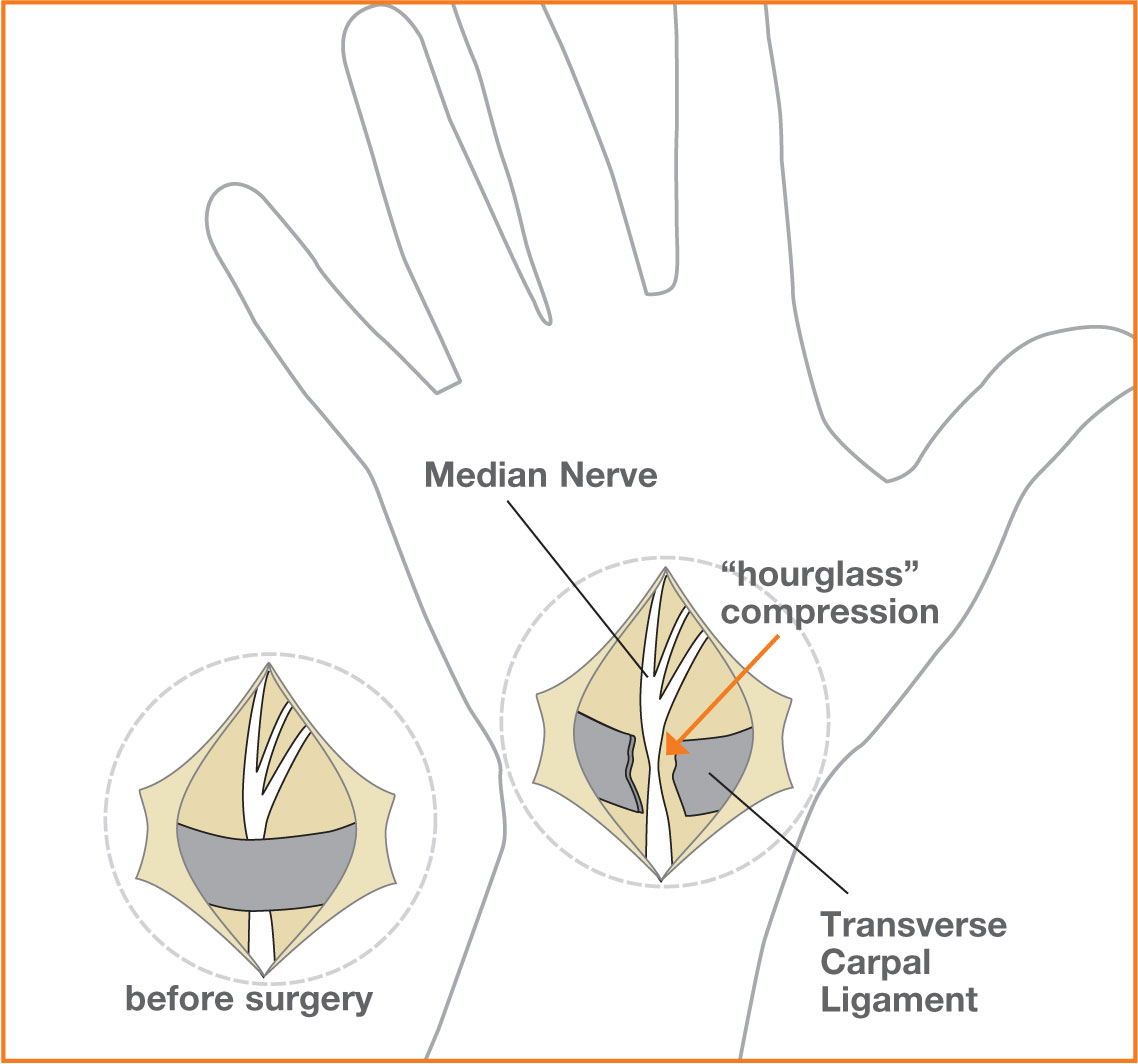 A diagram showing freeing the ligament by surgery