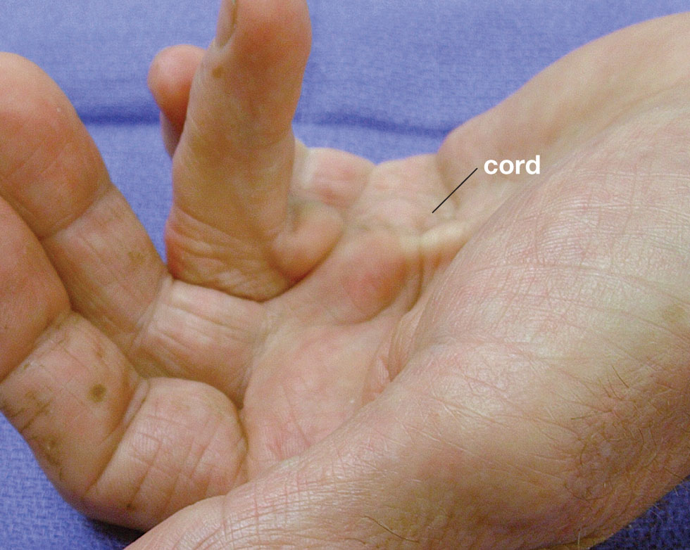 Advanced case of Dupuytren's with pits