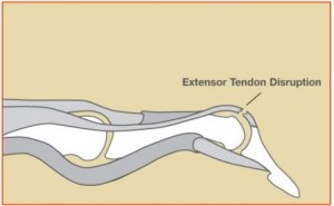 Diagram showing mallet finger deformity