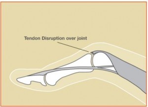 Diagram showing Boutonniere deformity