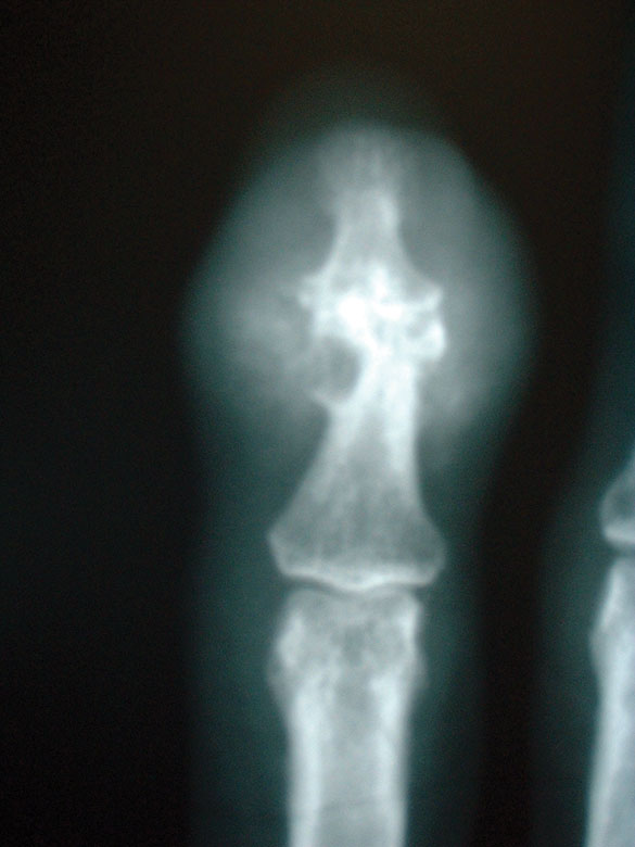 X-ray of finger with longstanding gout