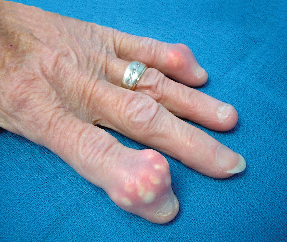 Gout image with tophus formation