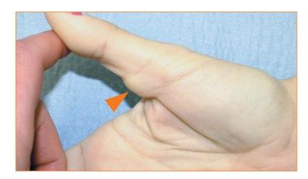 Image of giant cell tendon sheath tumor of the thumb