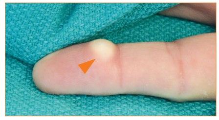 Epidermal inclusion cyst of the finger