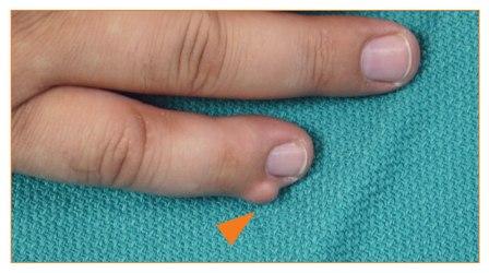 Fibroma of the little fingers