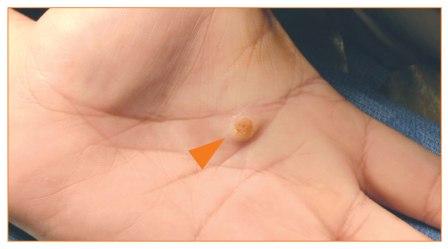Foreign body reaction causing tumor in the palm