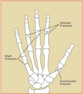 HandFrac1_c