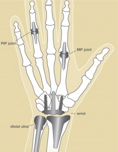 Image of Joint replacement implants