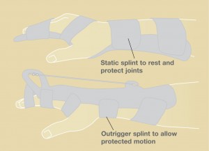 Common types of splints