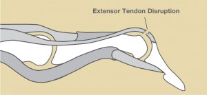 Diagram of Mallet Finger