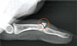 X-ray of mallet finger