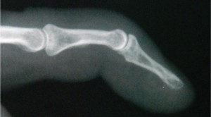 X-ray of mallet finger