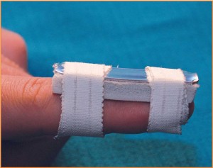 Splint supporting tip in extension