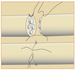 Nerve repair with realignment of bundles