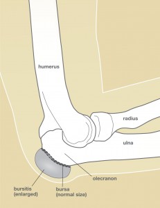 Bursitis_image1