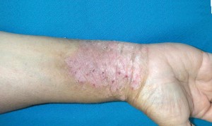 Image of scaly red patches on skin at wrist