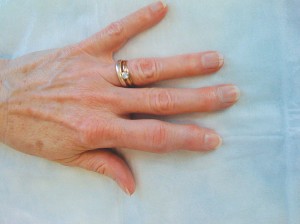 Image showing sausage finger with swelling on the middle joint