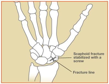 Diagram of screw in wrist