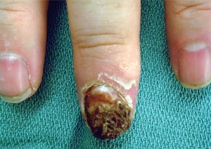 Squamous cell carcinoma looking like an infection
