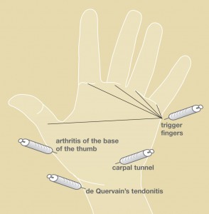 Steroid Injection sites