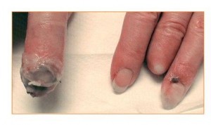 Image of finger with gangrene