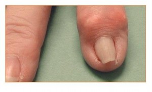 Image of deformity and enlargement of the small finger joint