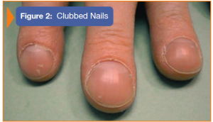 Image of clubbed nails