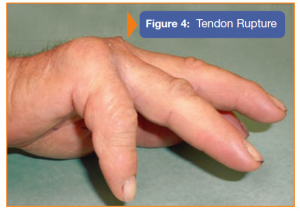 Image showing tendon rupture