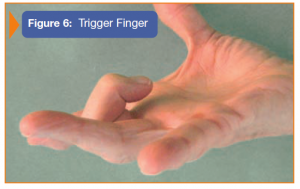 Image showing trigger finger