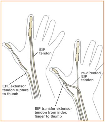 Image showing tendons on hand